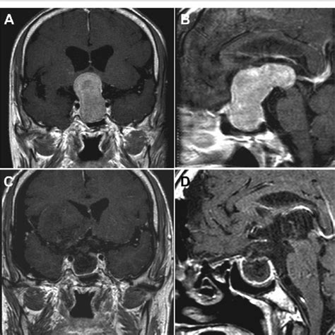 Giant Pituitary Adenoma Resection Via The Supraorbital Keyhole