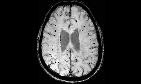 Could Mri Scans Be Used To Reduce Risk Of Stroke Patients Suffering