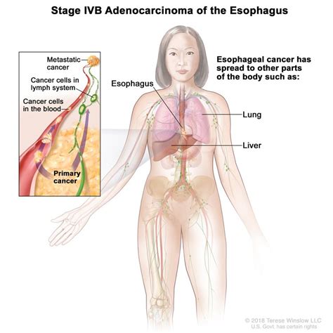 Esophageal Cancer Treatment Pdq Health Professional Version