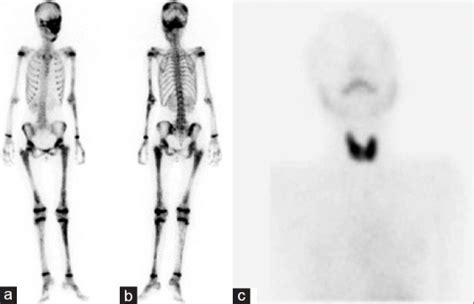 Tc M Mdp Whole Body Bone Scan In A Anterior And B Posterior Views