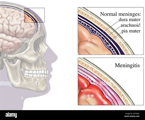 Bacterial Meningitis Meninges Hi Res Stock Photography And Images Alamy