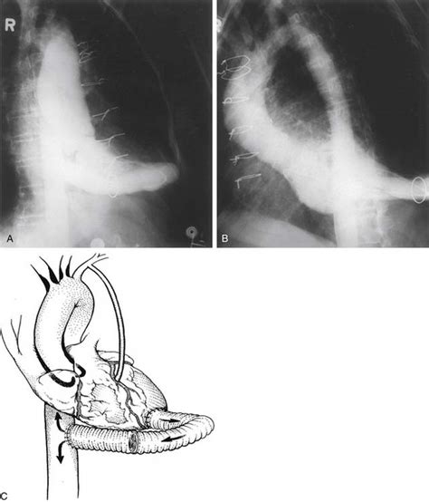 Surgery of the Aortic Arch | Thoracic Key