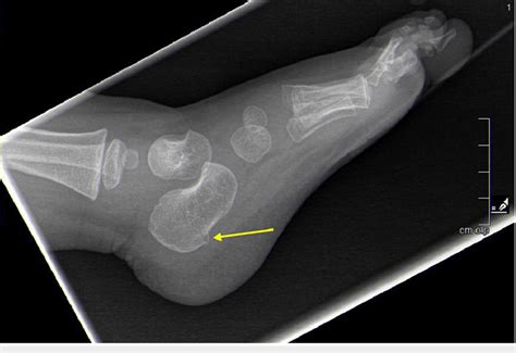 Lateral radiograph of the left foot demonstrating a toddler's fracture ...