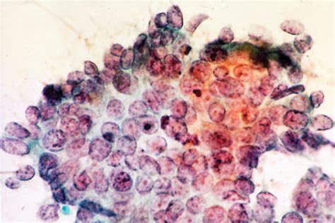 Figure 1 From Villoglandular Papillary Adenocarcinoma Of The Uterine