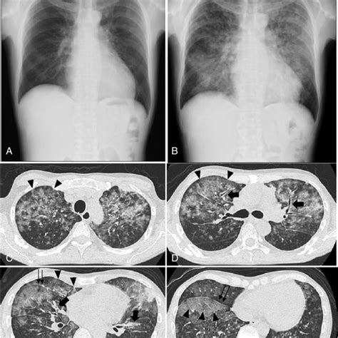 Normal chest X‐ray findings one month before admission to our hospital ...