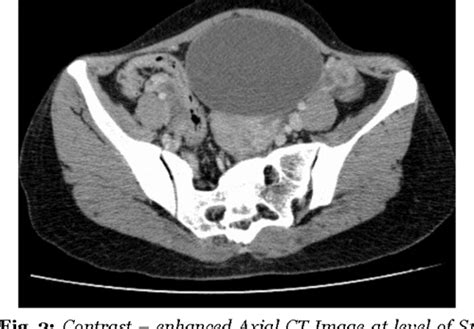 Figure 4 From The Unusual Sonographic Presentation Of Dermoid Cyst