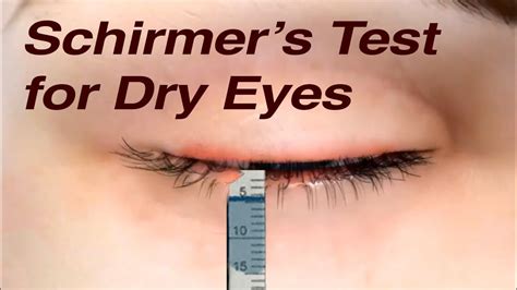 Schirmer S Test For Dry Eyes YouTube