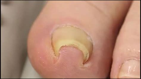 This Method Of Fixing An Ingrown Toenail Is Both Genius And Disgusting