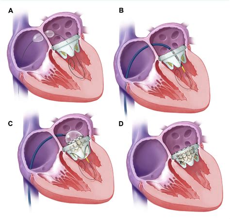 Figure 1 From Percutaneous Transvenous Transseptal Transcatheter Valve