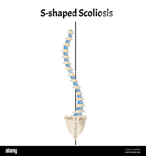 A Forma Di S La Scoliosi Dextroscoliosis Levoscoliosis Curvatura