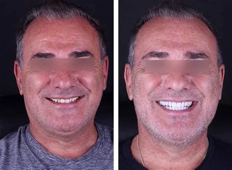 Bruxismteeth Grinding Treatment In Miami