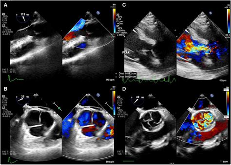 Transoesophageal Echocardiogram Showed Satisfactory Neoleaflets