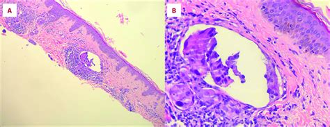 Duodenal Bulb Polyp Histologically Consistent With Benign Download Scientific Diagram