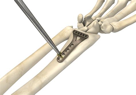 Distale Radiusplatte Ws Implantate Aus Koenigsee