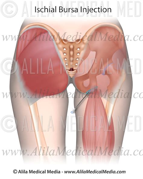 Ischial Bursitis