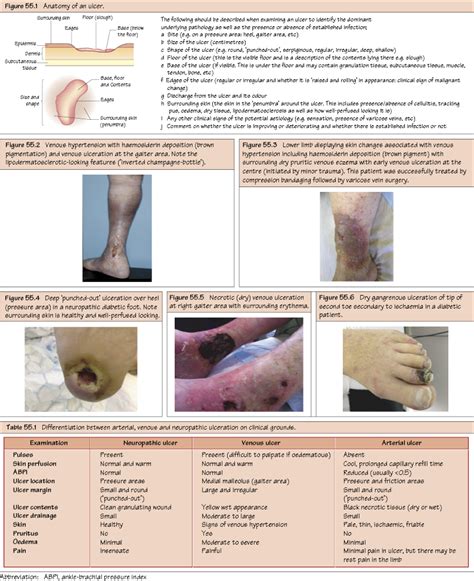 Arterial Ulcer