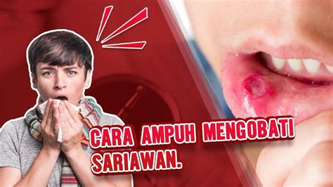 5 Cara Mudah Sembuhkan Bibir Sariawan Dengan Cepat Hanya Menggunakan