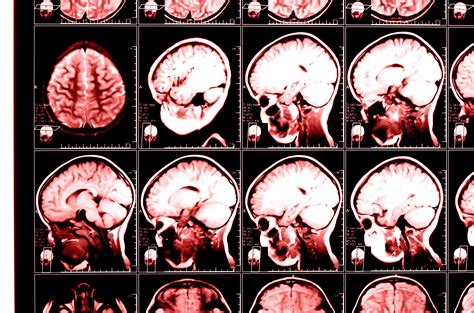 Identificación De Síntomas De Lesión Cerebral White Plains Nueva