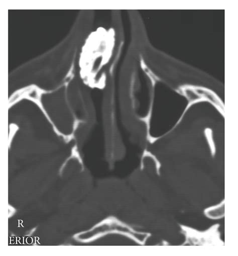 Axial Ct Scan Showing The Rhinolith In The Right Nasal Cavity With