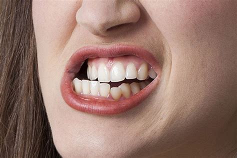 Teeth Grinding Bruxism Treatment Prevent Teeth Grinding Moorabbin