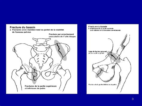 Fractures Du Bassin 1 Rappel Anatomique Bassin Osseux