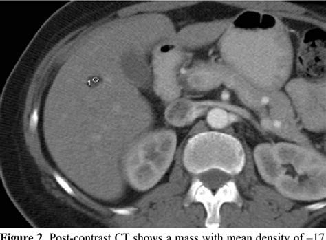 Figure 1 From Hepatic Lipoma Ct And Mri Findings Semantic Scholar