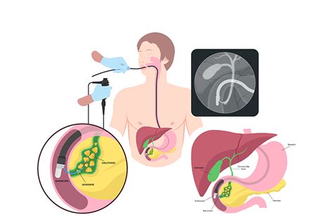 Endoscopia Digestiva Superioara Eds Reginamaria Ro