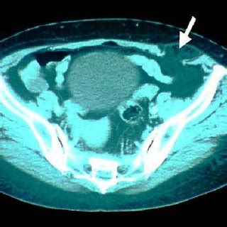 Tomodensitom Trie Abdominale Coupe Axiale Montrant Une Hernie De