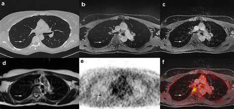 A 49 Year Old Female Patient With Histologically Proven Breast Cancer