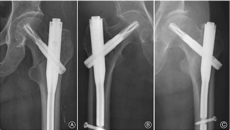 Proximal Fem Nail On X Ray Nail Ftempo