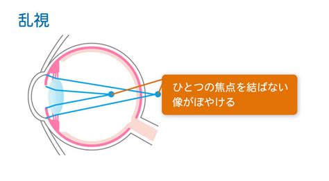 どれが自分に適している？コンタクトレンズの種類まとめ｜コンタクトレンズ通販情報サイト