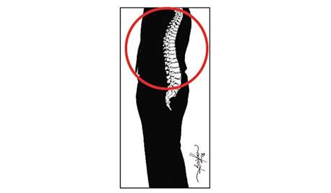 What is thoracic spondylosis? - Daily Trust