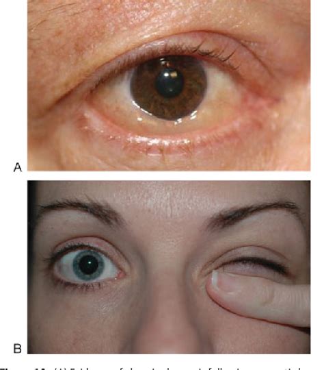 Table 3 From Blepharoplasty Complications Semantic Scholar