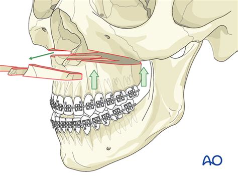 Orthognathic Surgery Fms Dental Hospital