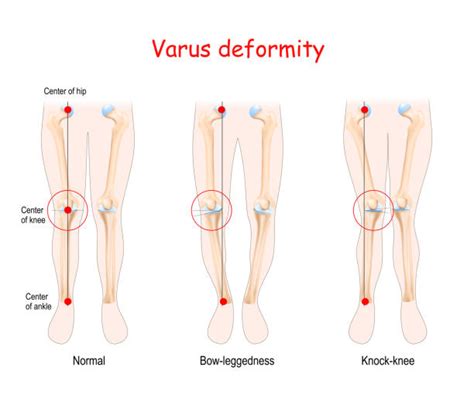 Knee Valgus Vs Varus