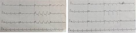 (a) 1 Electrocardiogram showed anteroseptal ST-elevation with... | Download Scientific Diagram