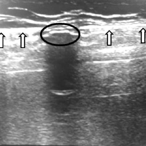 (PDF) Ultrasound Guidance for Intrathecal Baclofen Pump Refill