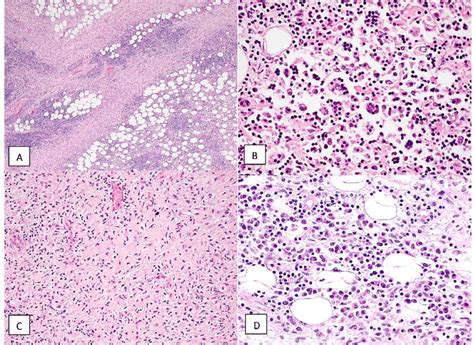 A Mixed Inflammatory Cell Infiltration In Adipose Tissue With Bands Of