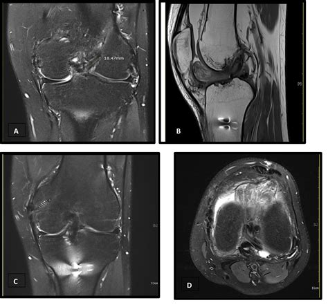 Figure 1 From Cyclops Lesion The Entity Causing Loss Of Knee