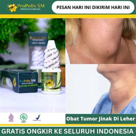 Jual Obat Tumor Jinak Di Leher Obat Kelenjar Tiroid Obat Kelenjar