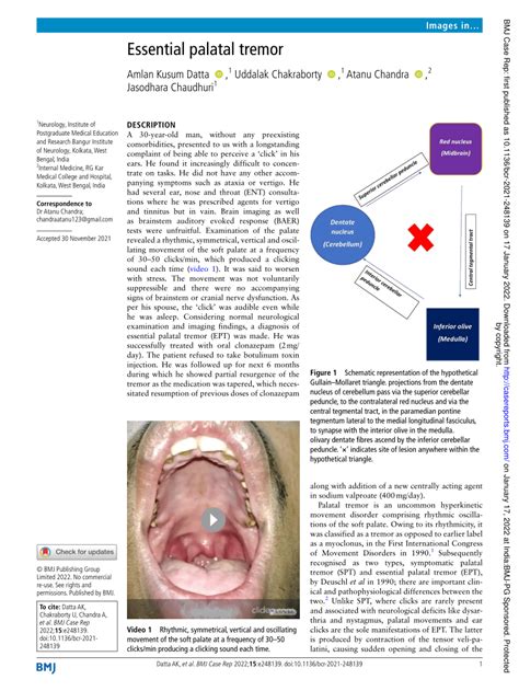 (PDF) Essential palatal tremor