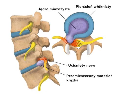 Przepuklina Kr Gos Upa Mo E Si Cofn