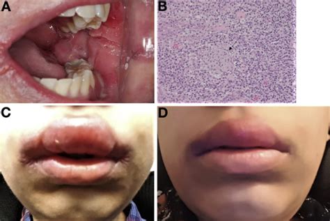 The Proof For Oral Crohn S Disease Is In The Cinnamon Free Pudding Clinical Gastroenterology