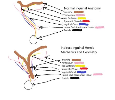 Femoral Hernia Diagram