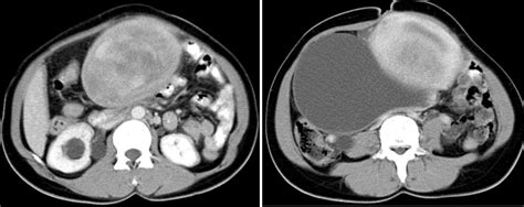 Ovarian Mucinous Cystadenoma And Uterine Leiomyoma Radiology Cases