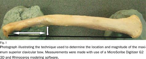 Figure 1 from Clavicular anatomy and the applicability of precontoured plates. | Semantic Scholar