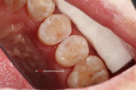 Fillings: Composite Resin. Where are the decayed cavities? | The Tooth, The Whole Tooth and ...