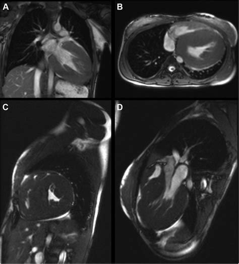 Cardiovascular Magnetic Resonance Showing Severe Free Wall And Septal