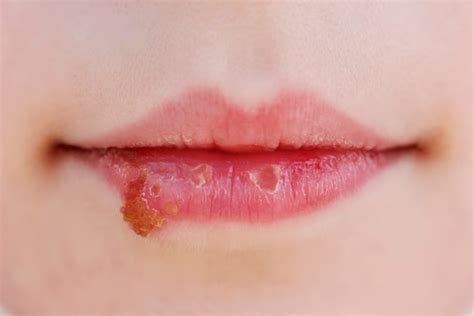 Herpes Labial Tratamento Causas Sintomas E Como Curar Minha Vida