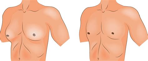 Effective Gynaecomastia Treatment for Men | Nexus Clinic